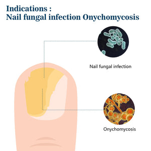 Fingernail Fungus Removal Light Therapy Treatment LLLT Nail